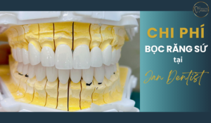 Chi Phí Bọc Răng Sứ tại Jan Dentist và Các Yếu Tố Ảnh Hưởng Đến Giá Cả